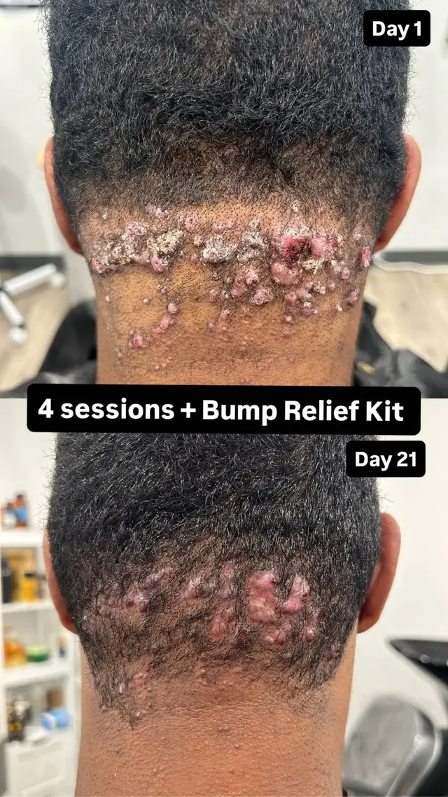 Documented client neckline timeline: Day 1 compared with Day 21 after four sessions plus the BUMP Relief Kit