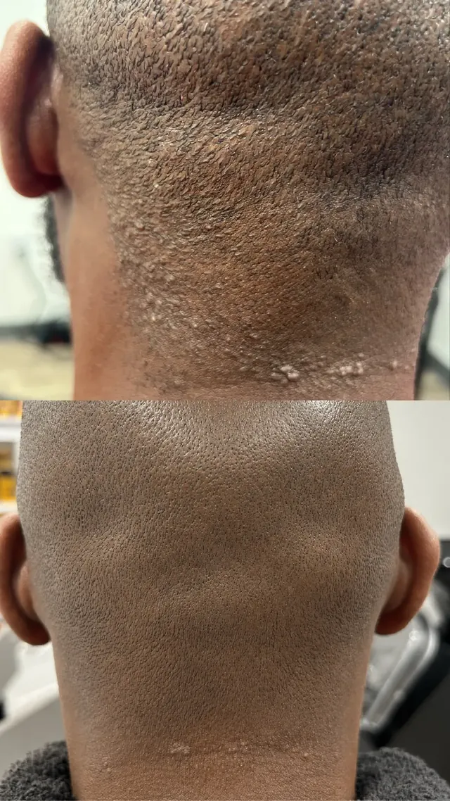 Before and after: corrective neckline care for severe recurring bumps on the back of the neck