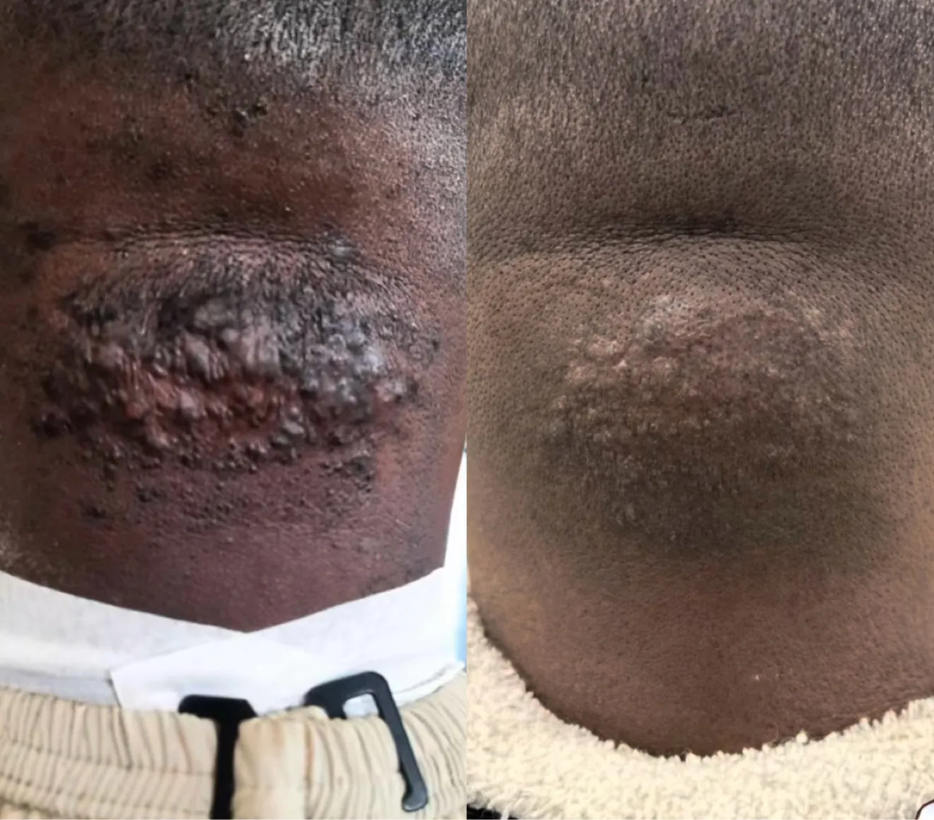Before and after: corrective neckline care for recurring bumps and irritation along the neckline