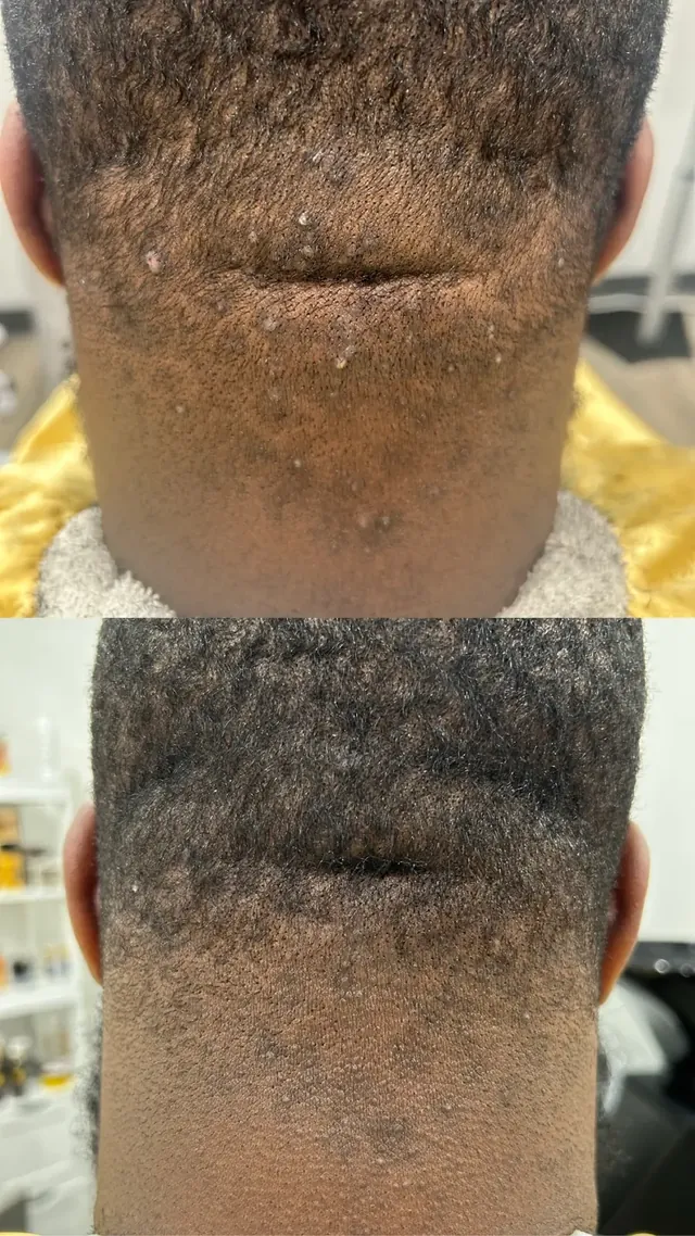 Before and after: corrective neckline care for bumps across the back of the neck