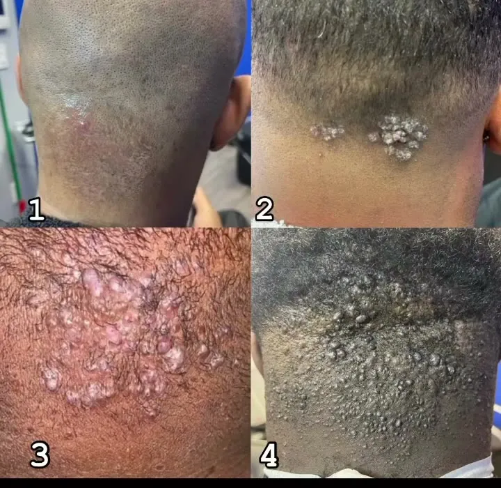 AKN severity levels 1 through 4 — what level are you?